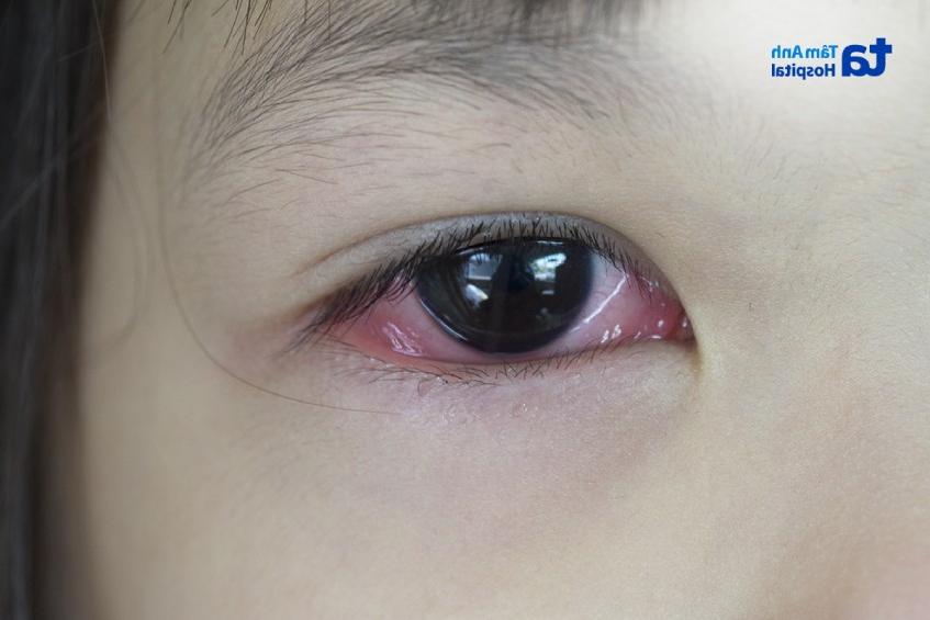 Bệnh đau mắt đỏ khiến mắt sưng đỏ, khó chịu