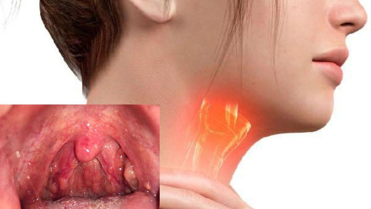 Hình ảnh amidan bị sưng viêm gây ra triệu chứng vướng cổ họng