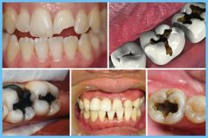 Chi phí trám răng hết bao nhiêu và có cho hiệu quả lâu dài không?